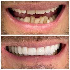 Veneers
