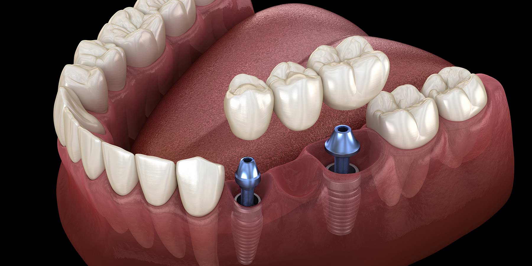 implants